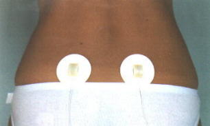 Bei Ischias-Beschwerden die Elektroden beiderseits auf die Venusgrübchen kleben