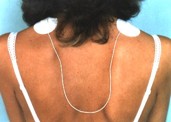 Bei Nackenschmerzen beide Elektroden auf die typischen Druckschmerzpunkte beiderseits auf dem Schulterkamm kleben.